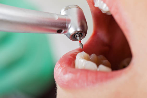 Best Emergency Root Canal Treatment in Bellville, TX